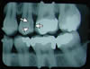 x-ray with cavity